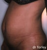 Tummy Tuck