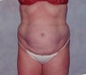 Tummy Tuck