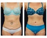 Abdominoplasty - Tummy Tuck