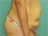 Tummy Tuck