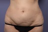 50 yr old wanting liposuction and a tummy tuck