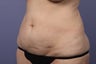 50 yr old wanting tummy tuck and liposuction