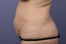 50 yr old wanting tummy tuck and liposuction