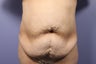 65 yr old wanting tummy tuck and liposuction