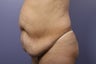 65 yr old wanting tummy tuck and liposuction