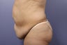65 yr old wanting tummy tuck and liposuction