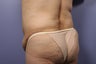 65 yr old wanting tummy tuck and liposuction
