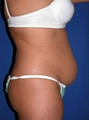 Tummy Tuck, liposuction