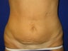 Tummy Tuck