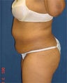 Tummy Tuck