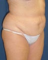 Tummy Tuck