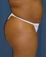 Tummy Tuck