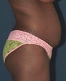Tummy Tuck