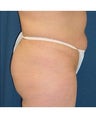 Tummy Tuck