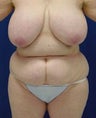 Tummy Tuck