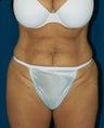 Tummy Tuck