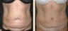 Abdominoplasty