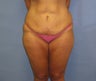 Tummy Tuck