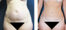 AbdominalPlasty and Umblical Hernia Repair