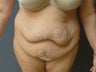Tummy tuck