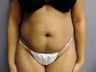 Tummy Tuck