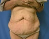 Tummy Tuck