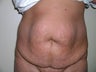 Tummy Tuck or Abdominoplasty
