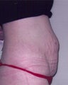 Tummy Tuck