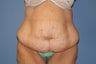Tummy Tuck
