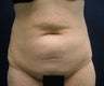 Tummy Tuck
