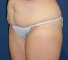 Tummy Tuck