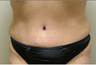 Tummy Tuck