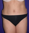 Tummy Tuck (abdominoplasty)
