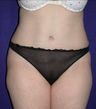 Tummy Tuck