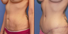 Abdominoplasty