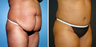 Tummy Tuck (Abdominoplasty) with Liposuction