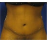 Tummy Tuck