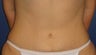 Tummy tuck