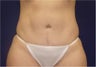 Tummy tuck