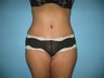 tummy tuck