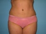 tummy tuck