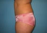 tummy tuck