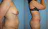 Tummy Tuck