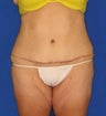 Tummy Tuck