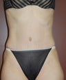 Tummy Tuck