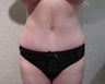 Tummy Tuck