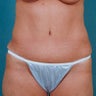 Tummy Tuck