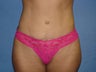 Tummy Tuck