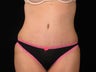Tummy Tuck