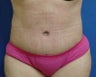 Tummy Tuck